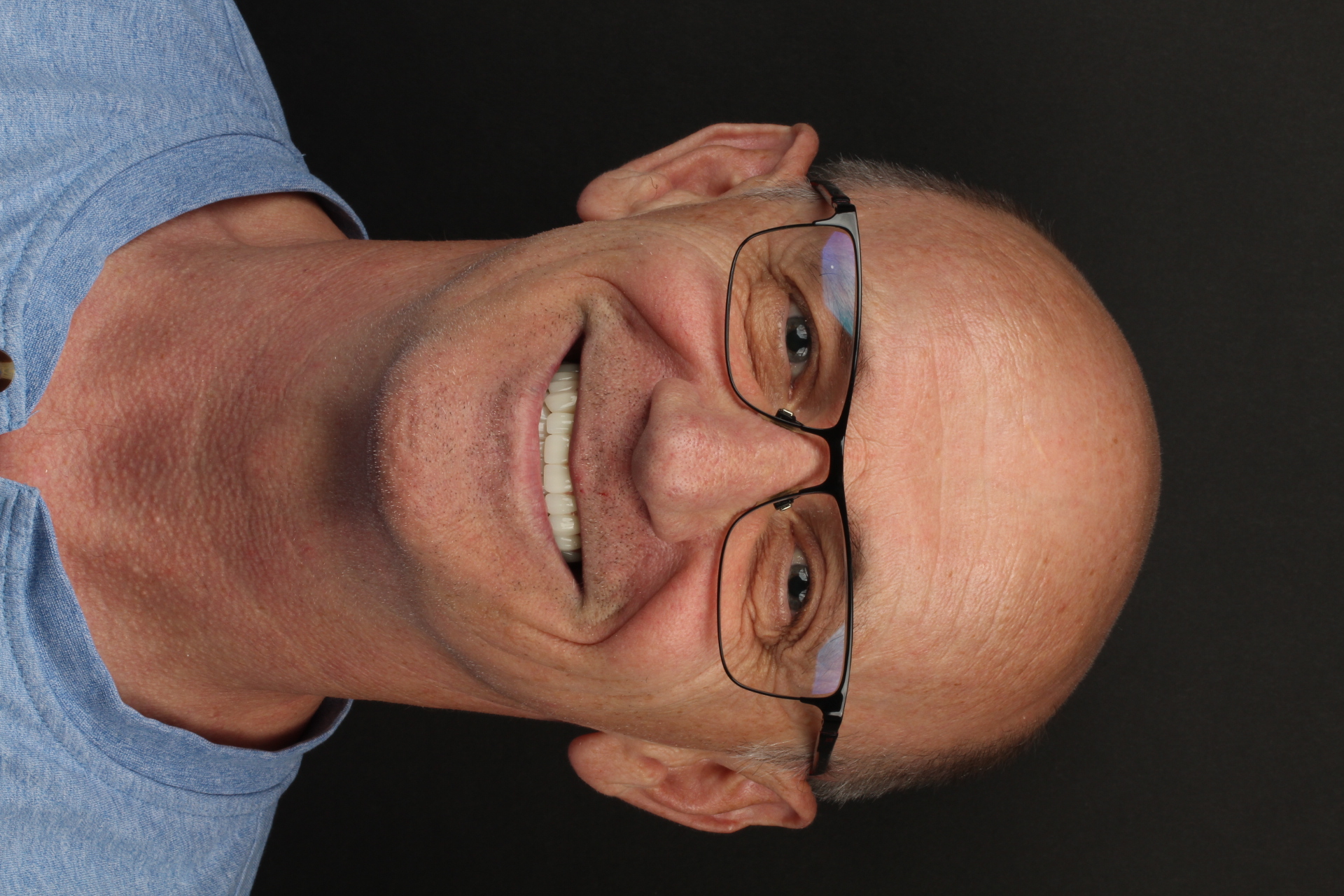 Zirconium Crowns case result