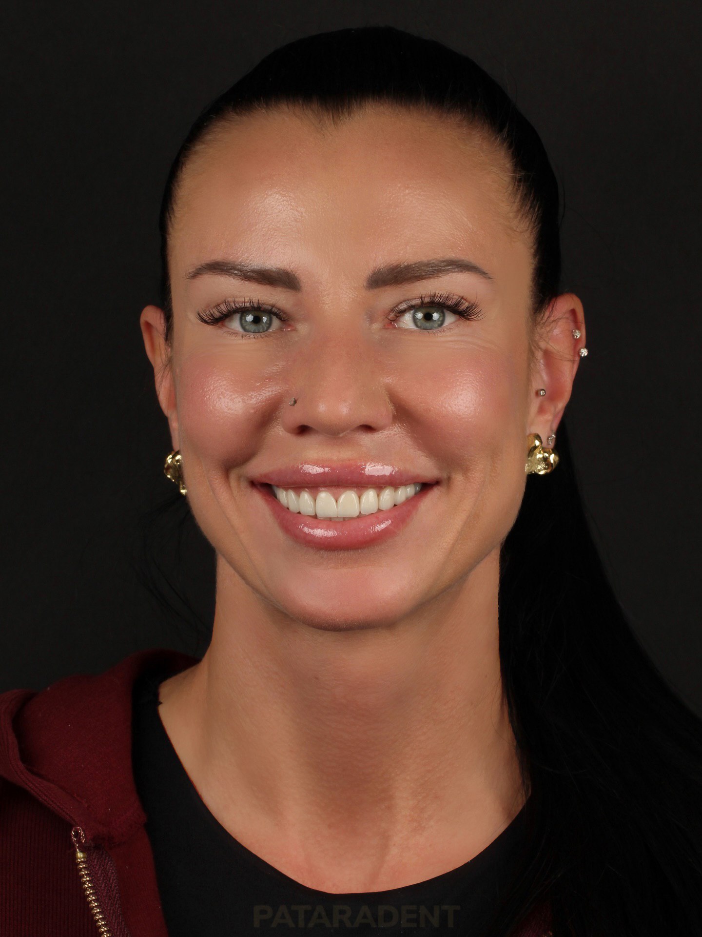 E-Mex Veneers case result