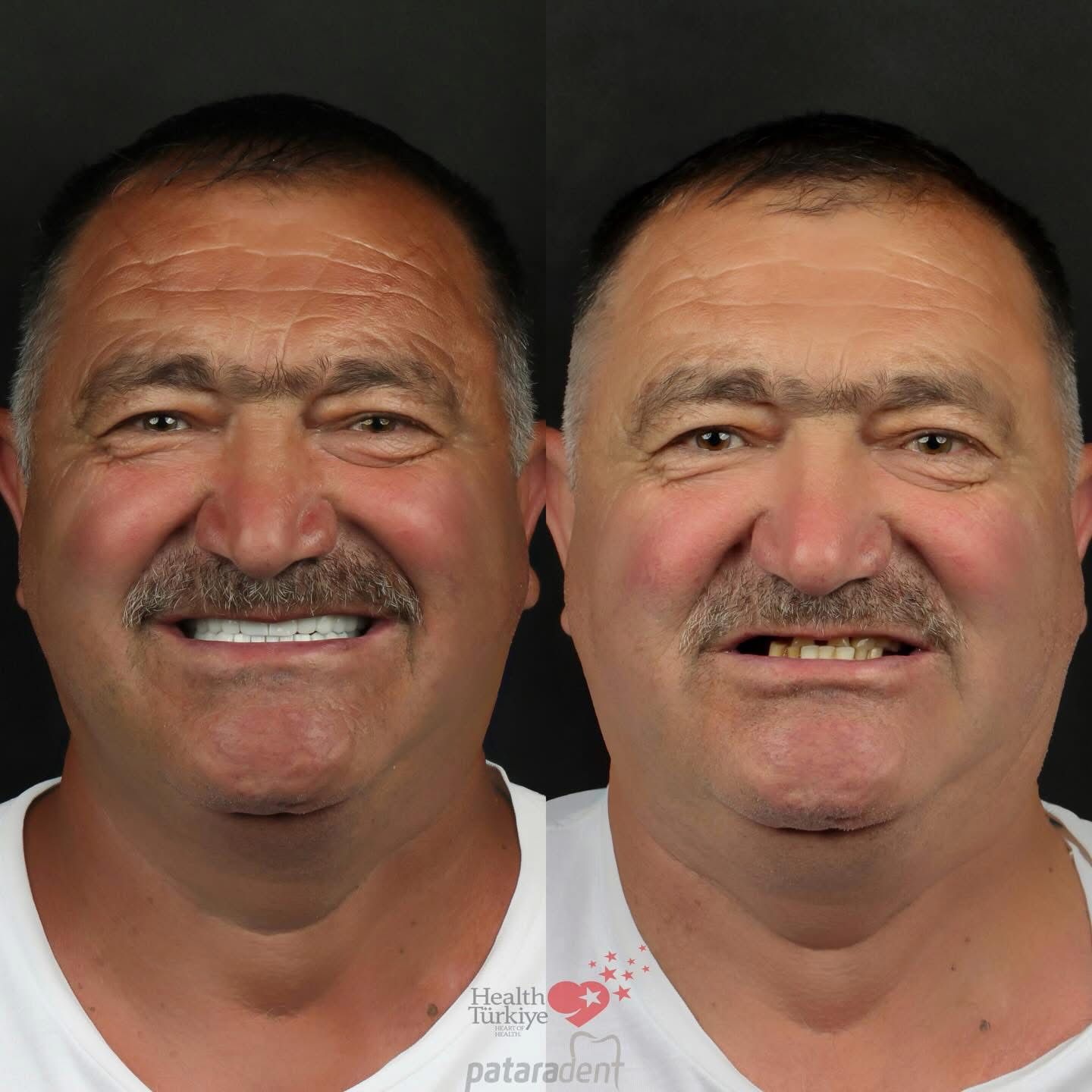 Dental Prosthetics case result