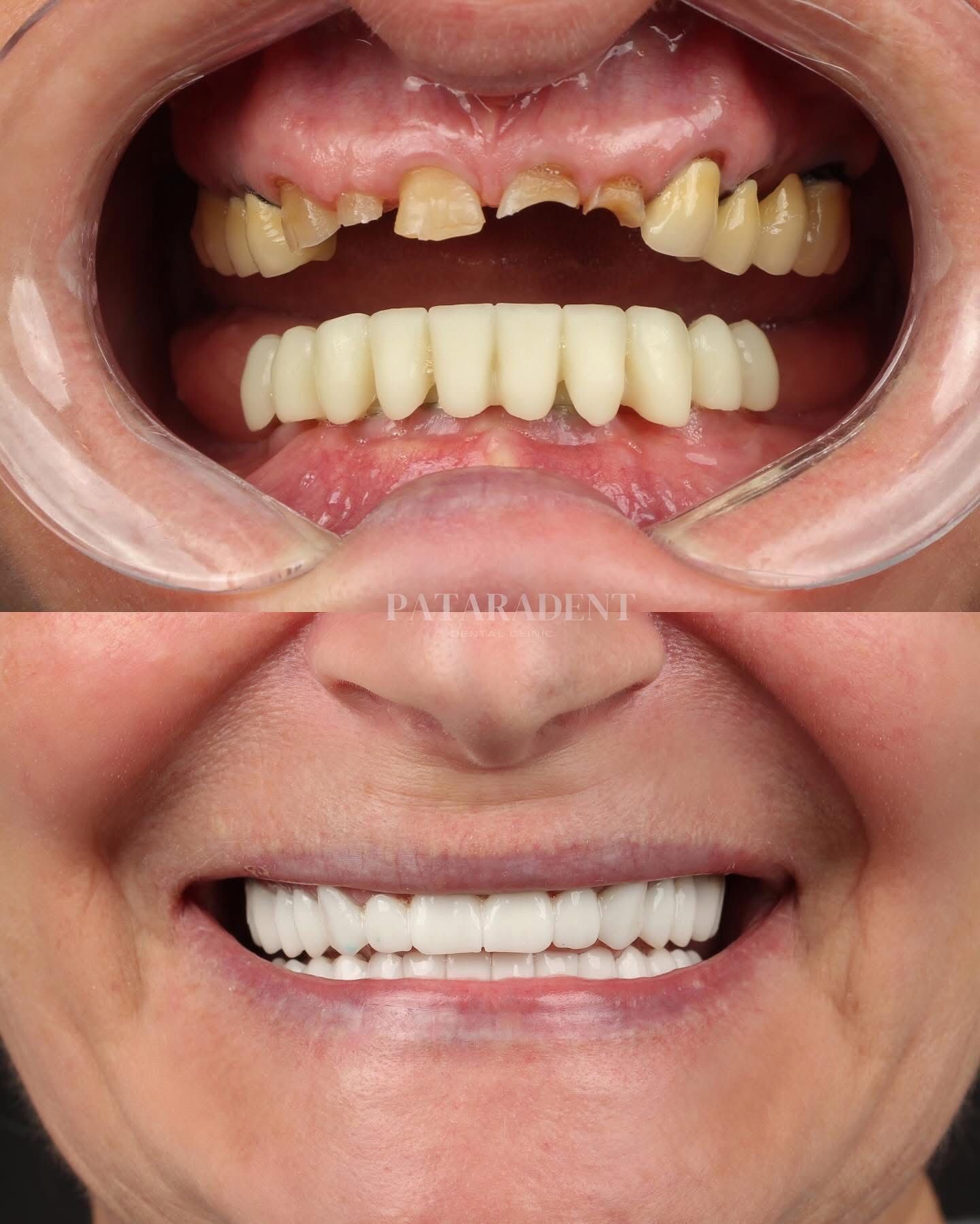 Prosthetic care preview