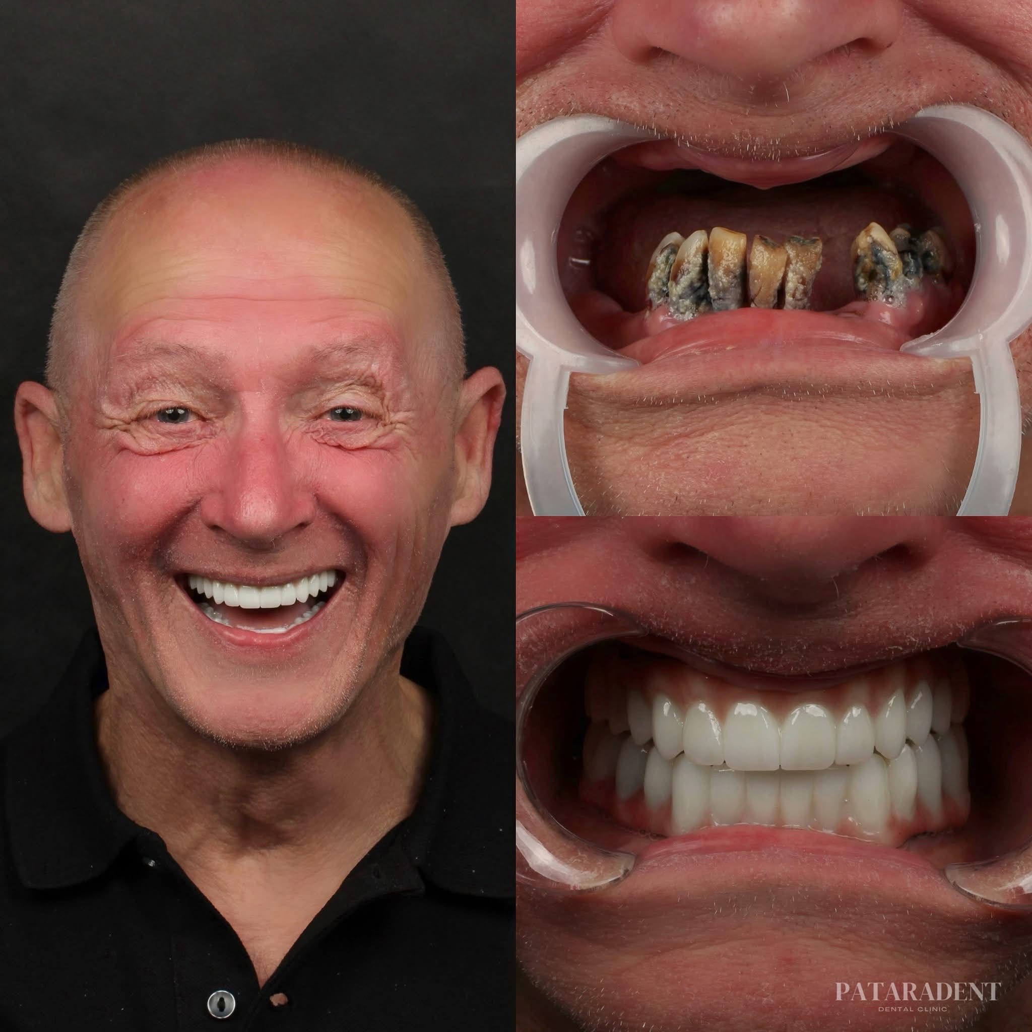 All On 4 and All On 6 case result