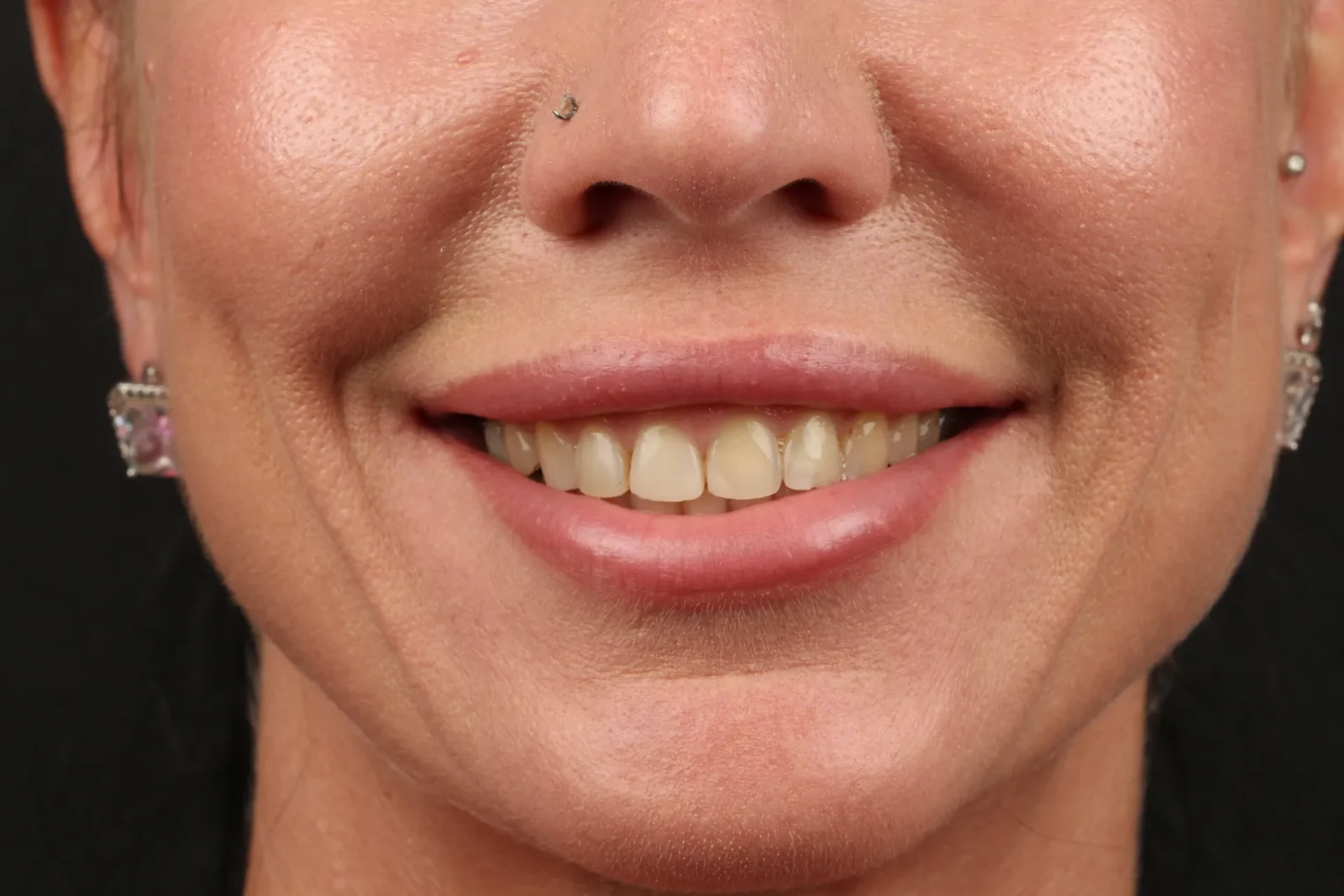 Patient before dental veneer treatment, frontal facial view