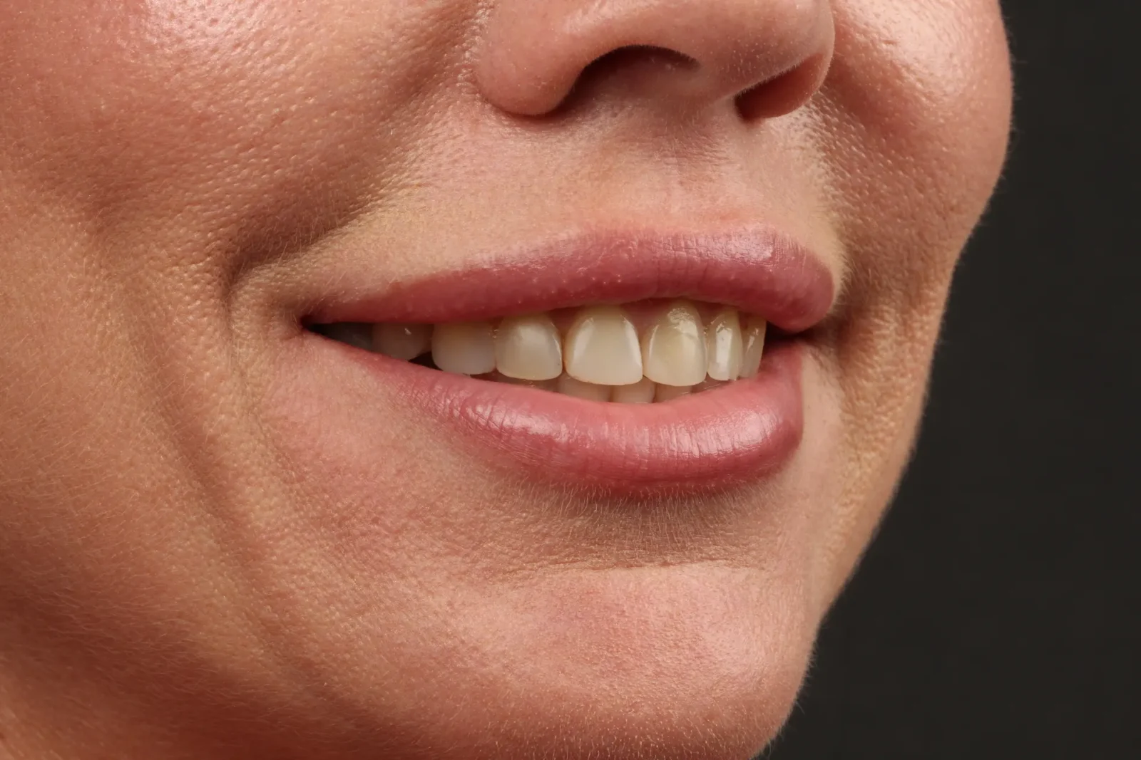 Patient before dental veneer treatment, right oblique facial view