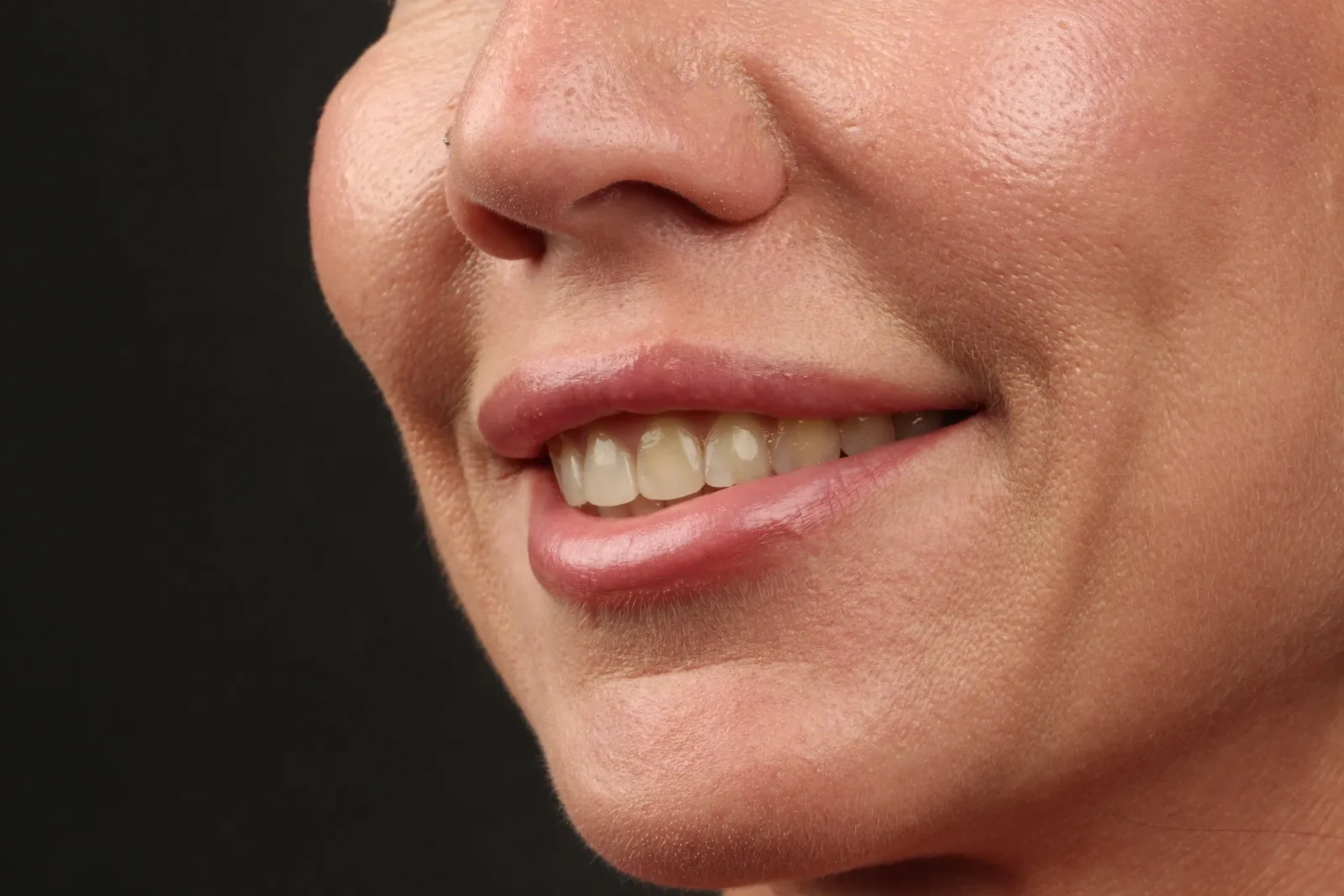 Patient before dental veneer treatment, left oblique facial view