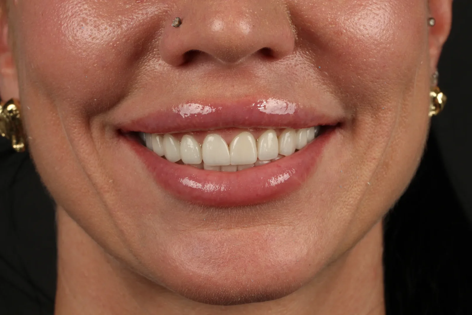 Patient after dental veneer treatment, frontal facial view