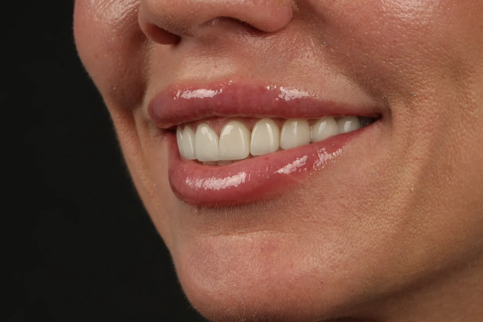 Patient after dental veneer treatment, left oblique facial view