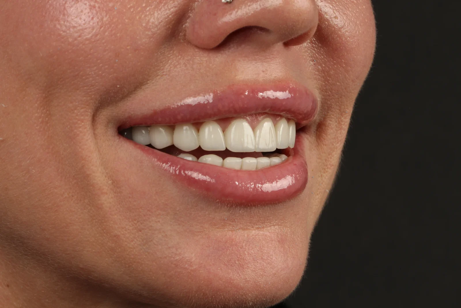 Patient after dental veneer treatment, right oblique facial view