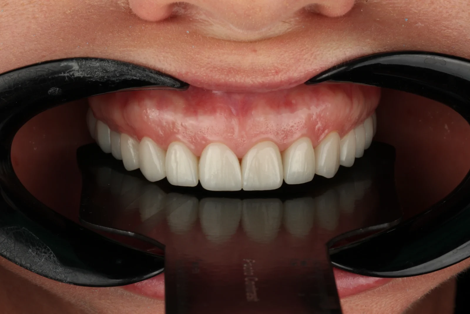 Intraoral view after dental veneer treatment