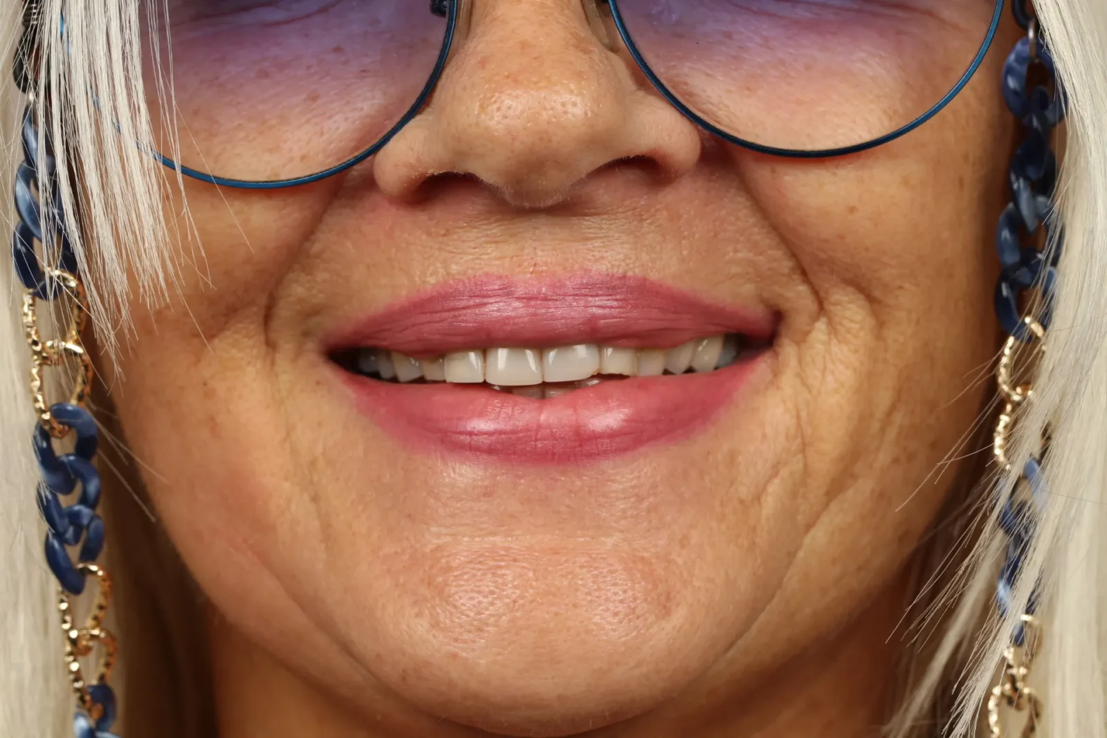 Patient before zirconium crown treatment, frontal facial view