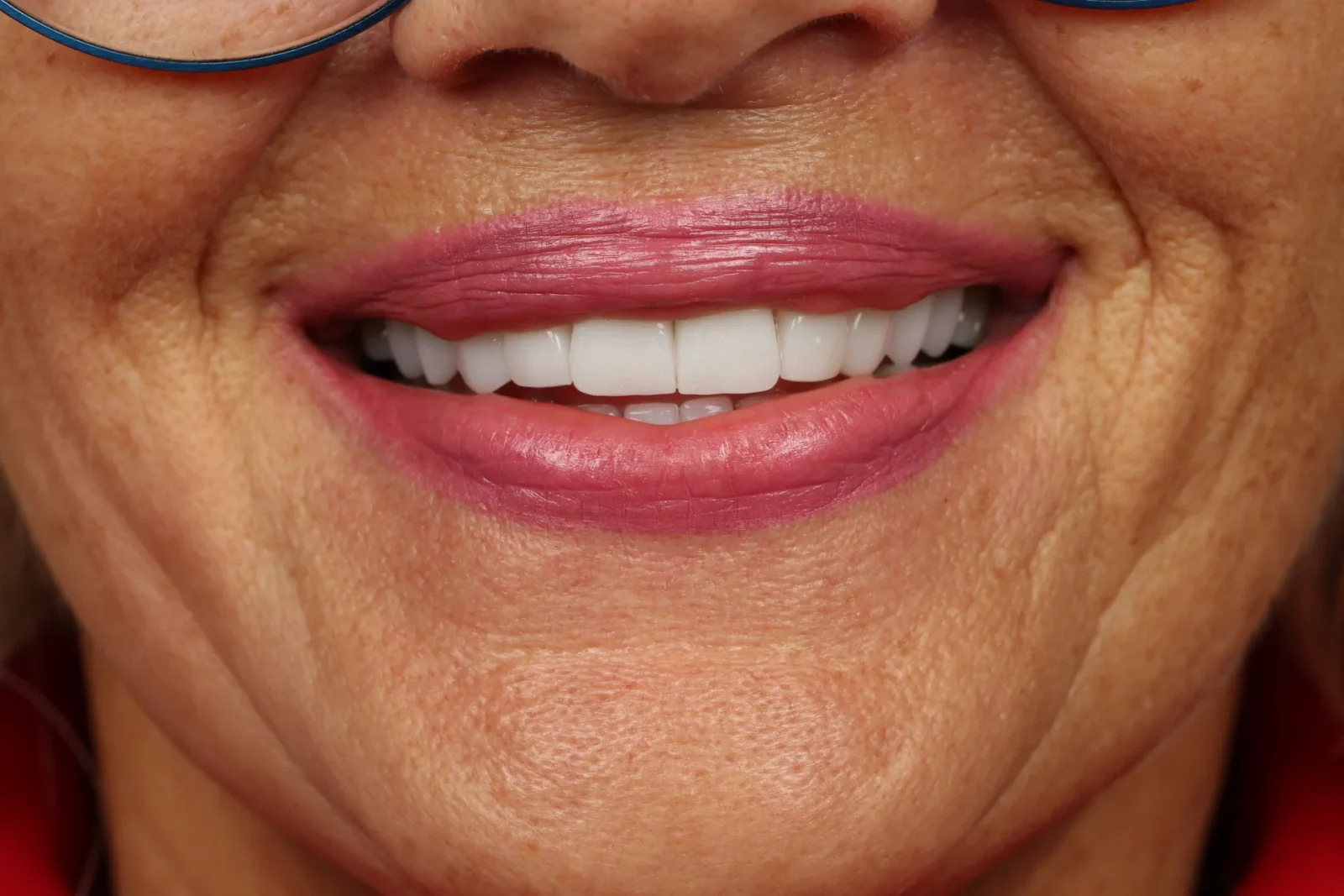 Patient after zirconium crown treatment, frontal facial view
