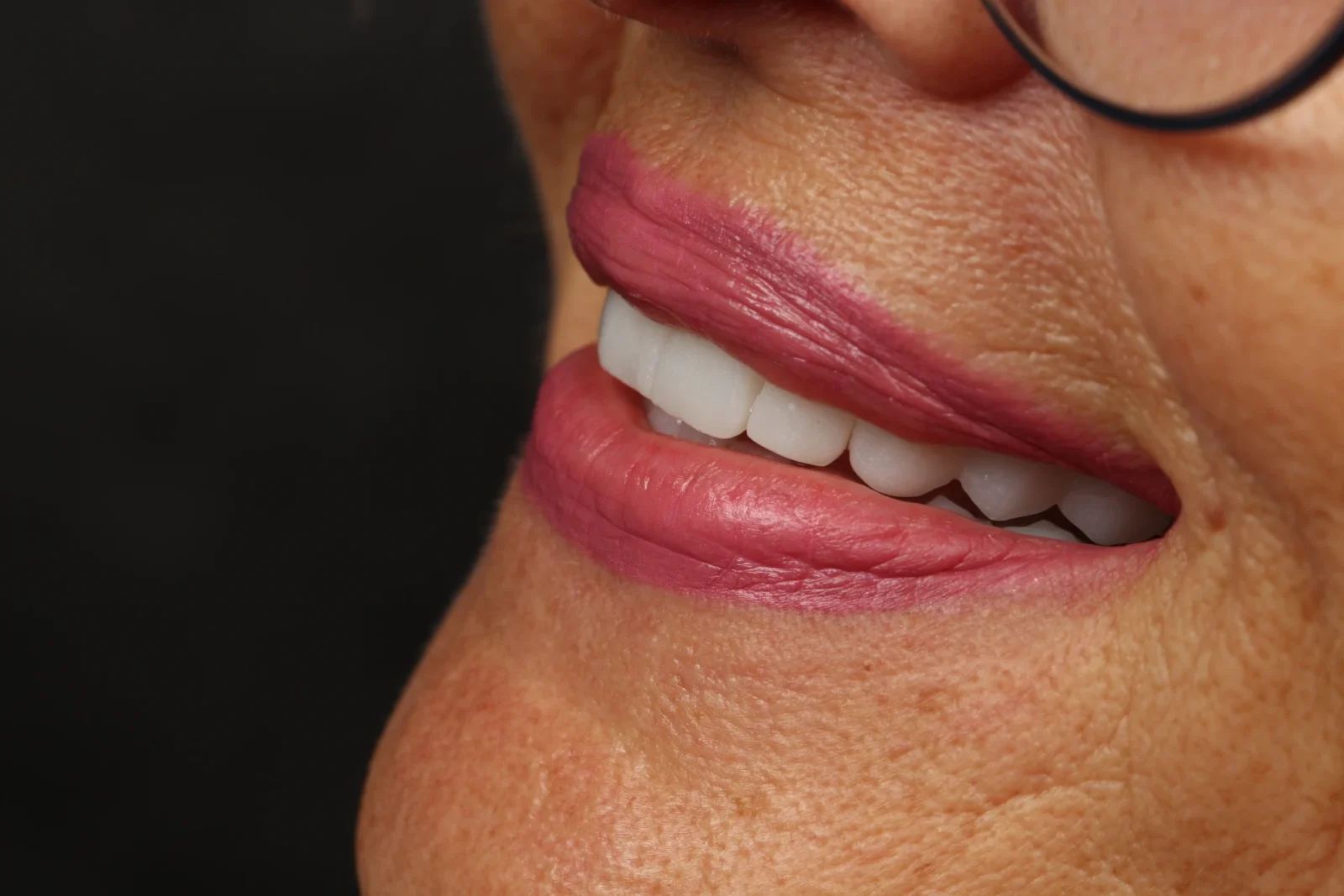 Close-up view of the patient’s smile after zirconium crown treatment