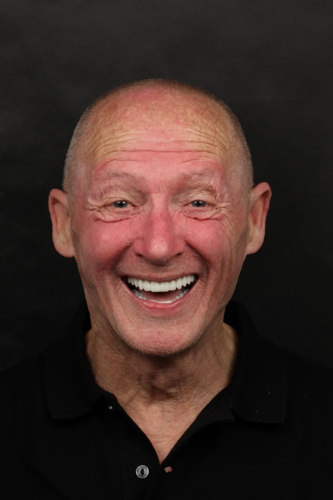 Patient after All-on-4 full-arch implant rehabilitation