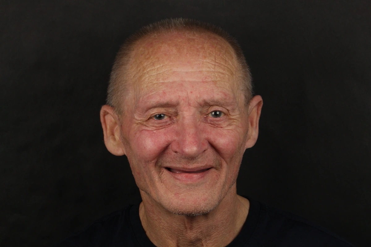 Patient before All-on-4 full-arch implant rehabilitation