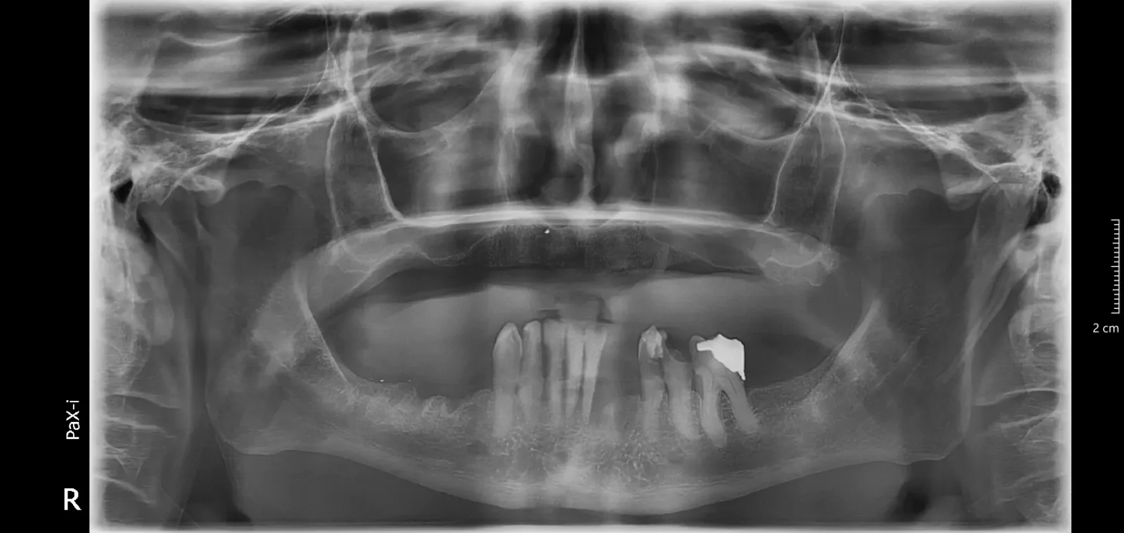 Panoramic radiograph taken before All-on-4 full-arch implant rehabilitation