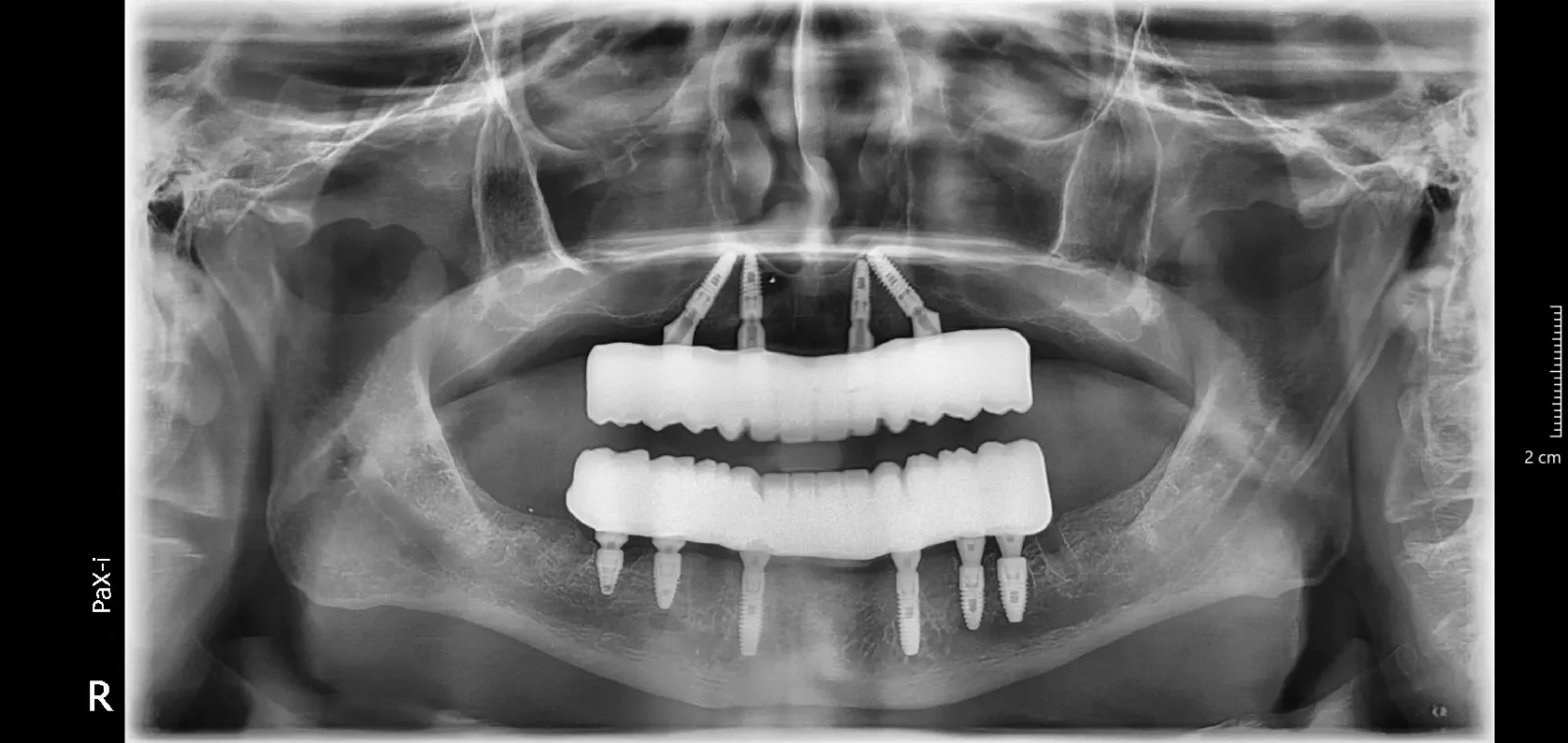 Panoramic radiograph taken after All-on-4 full-arch implant rehabilitation