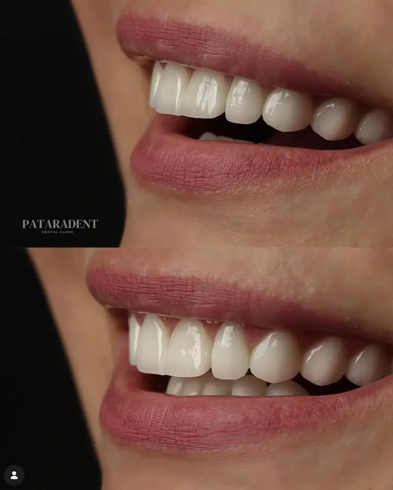 Dental veneer restoration case treated at Patara Dent