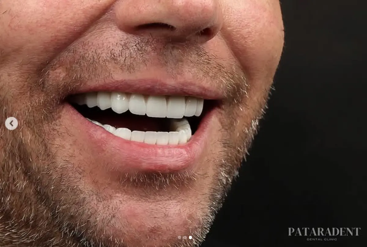 Full arch implant restoration case treated at Patara Dent