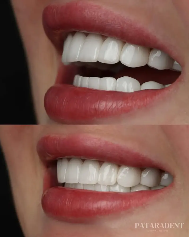 Teeth whitening treatment result at Patara Dent