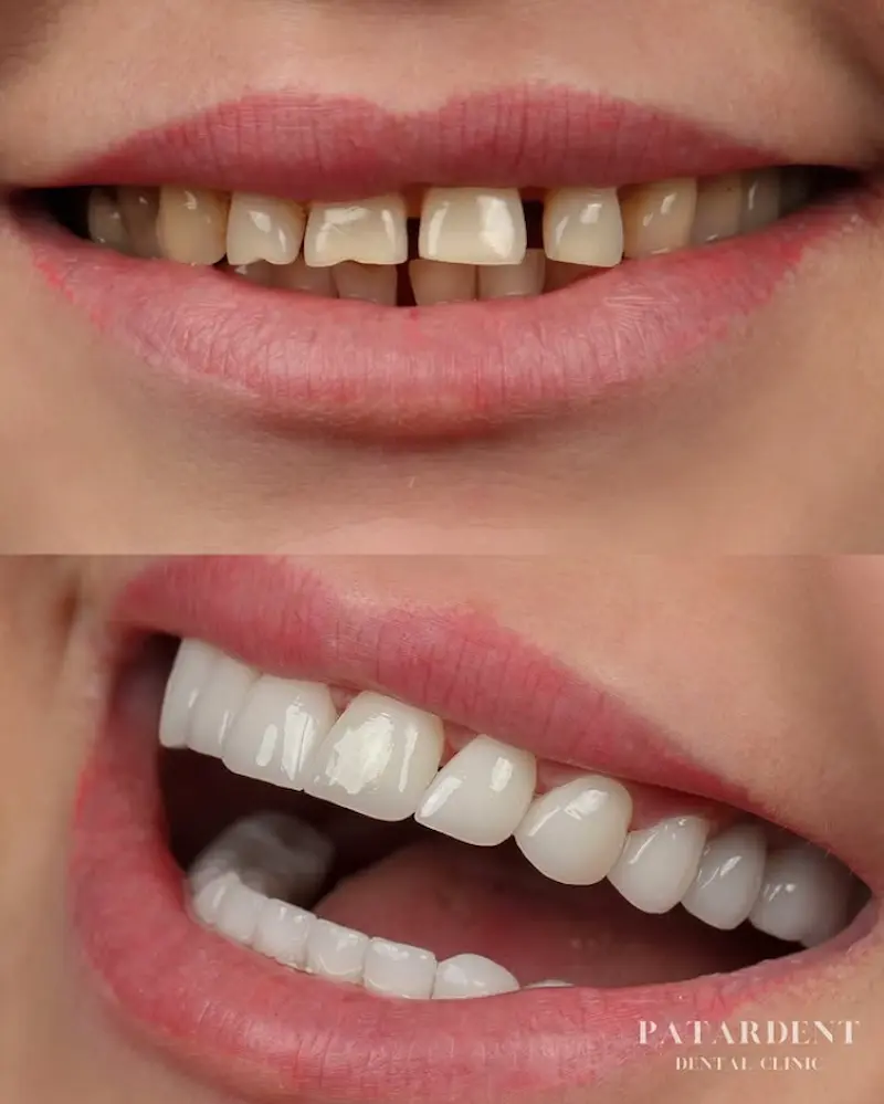 Hollywood Smile treatment case at Patara Dent