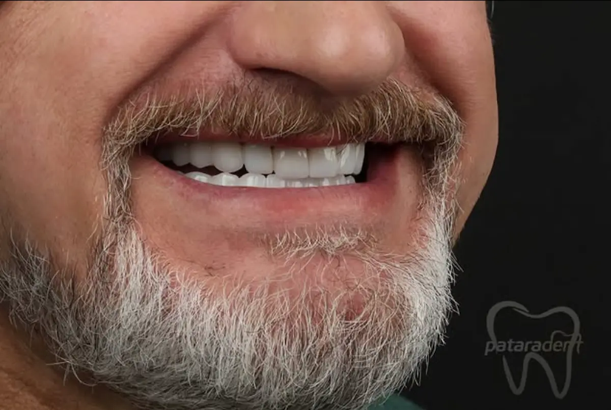 Dental implant restoration case treated at Patara Dent